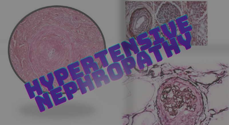 Hypertensive Nephropathy
