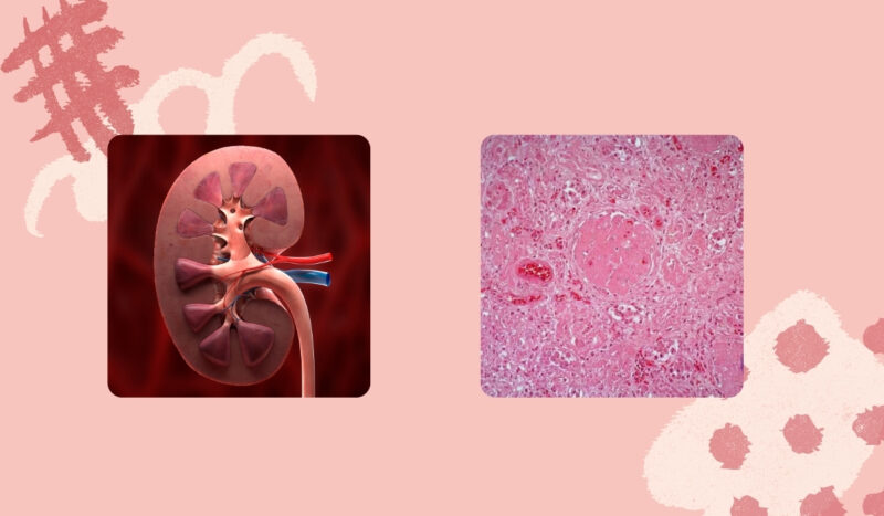 Malignant Nephrosclerosis