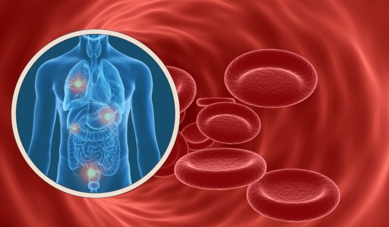 Metastatic Malignancies