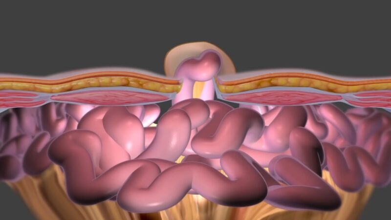 Inguinal Hernia