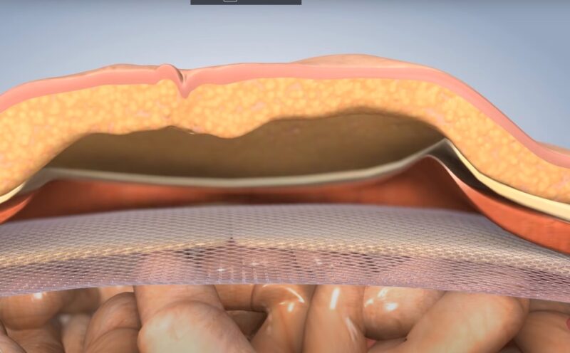 Inguinal Hernia surgery