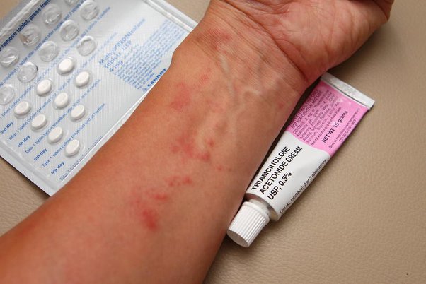 Triamcinolone Acetonide Cream Archives - Pathway Medicine