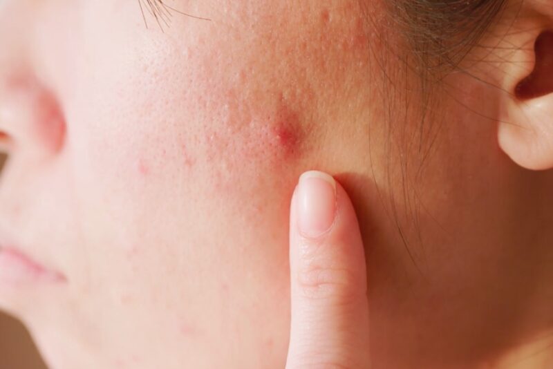 Skin Bacteria and Acne