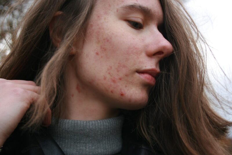 Why Do Teenagers Get Acne - Secrets & Solutions!