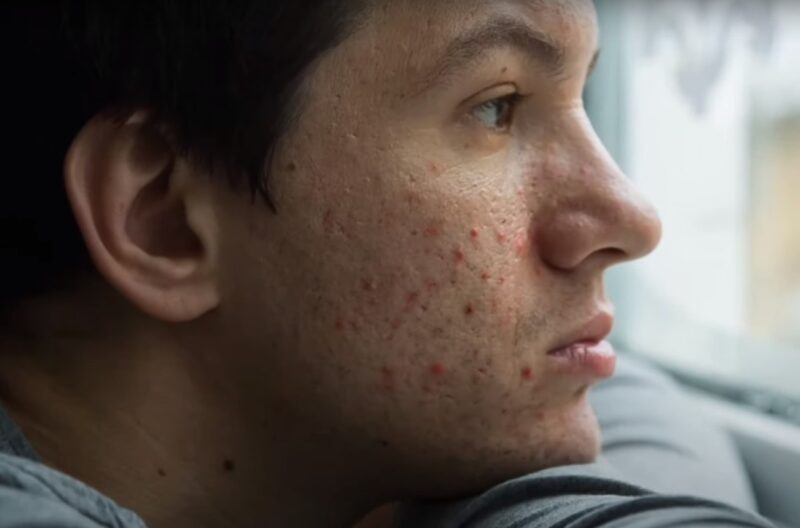 Cystic Acne