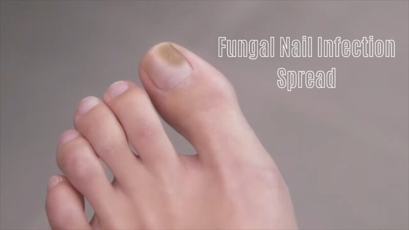 Check out if fungal nail infections can spread and get some tips to keep yourself healthy.