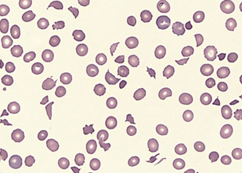 Microangiopathic Hemolytic Anemia (MAHA)